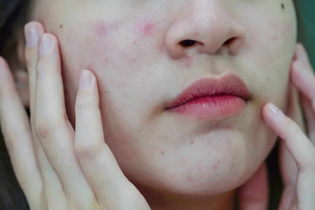 acne treatment